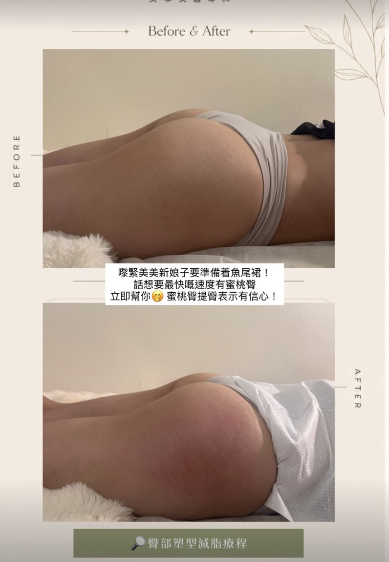 美體案例 01・臀部護理，原圖上方為護理前，下方為護理後