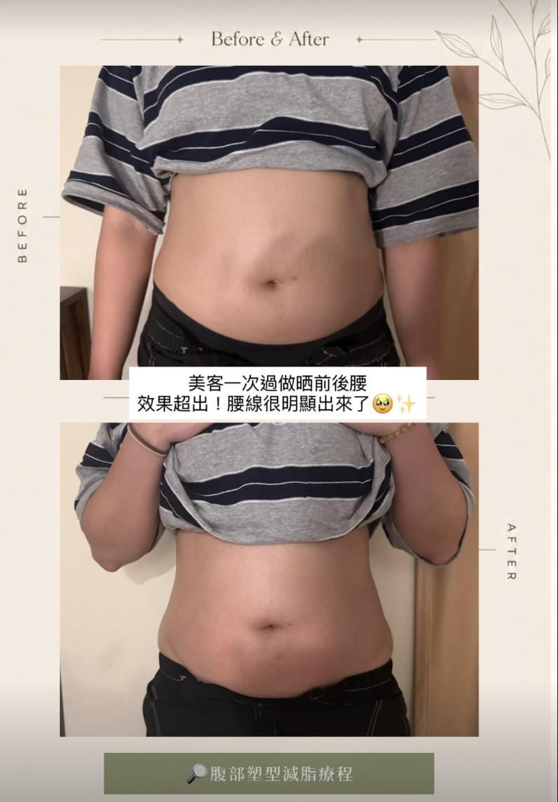 美體案例 06・腹部護理，原圖上方為護理前，下方為護理後