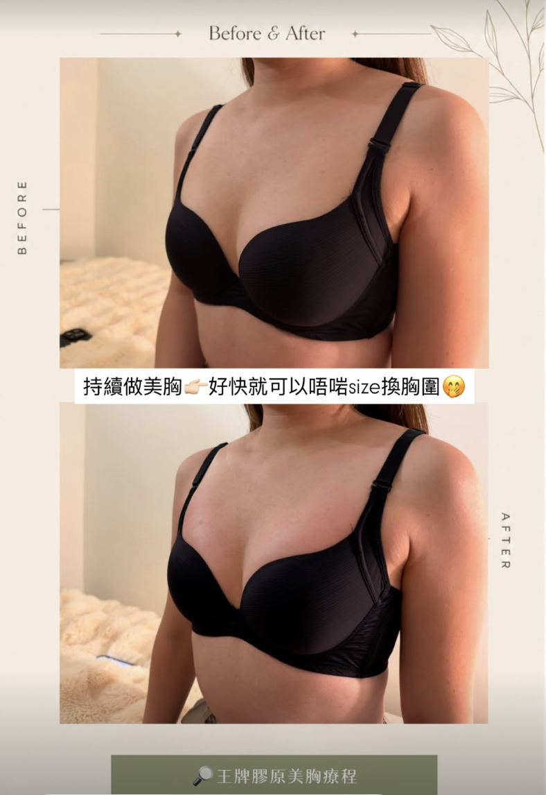 美胸案例 01，原圖上方為療程前，下方為療程後