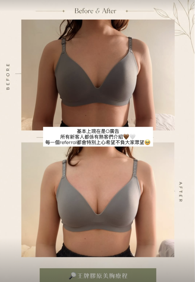 美胸案例 02，原圖上方為療程前，下方為療程後