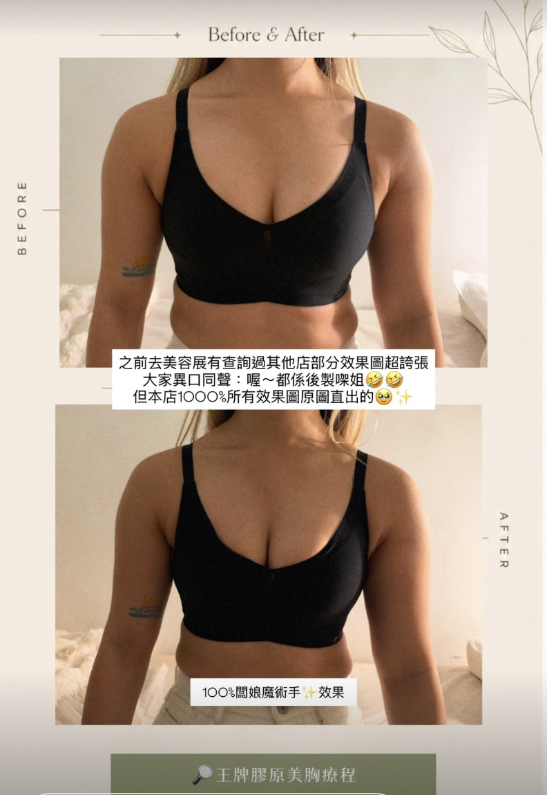 美胸案例 03，原圖上方為療程前，下方為療程後