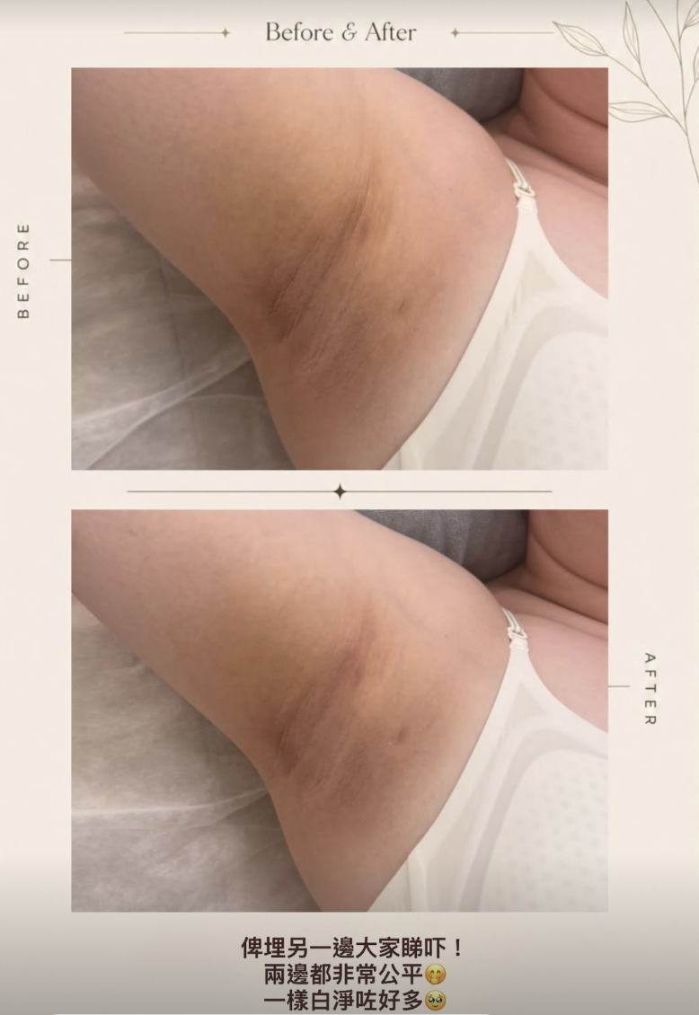 Dactor Peel 腋下煥膚案例，原圖上方為護理前，下方為護理後